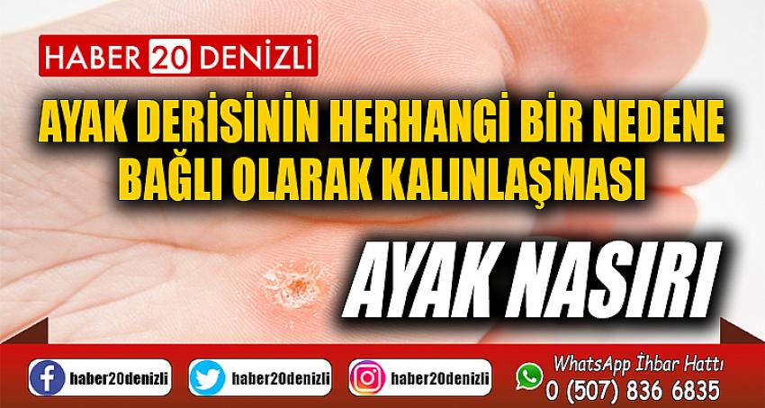 Ayak derisinin herhangi bir nedene bağlı olarak kalınlaşması: Ayak Nasırı