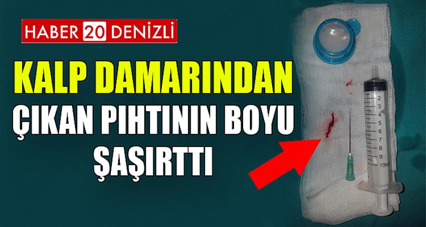 KALP DAMARINDAN ÇIKAN PIHTININ BOYU ŞAŞIRTTI